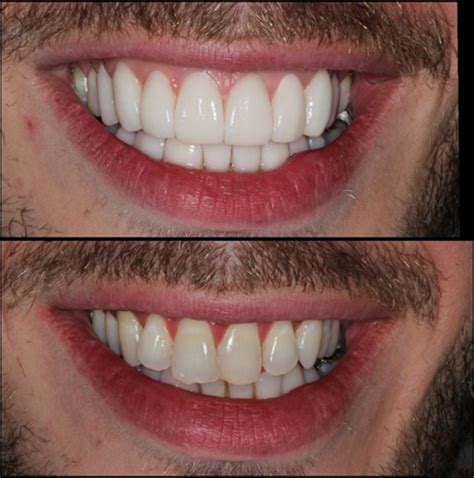 Veneers | Cosmetic Dentistry Center