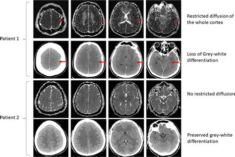 Neuroimaging of hypoxic ischemic brain injury after cardiac arrest. Two... | Download Scientific ...
