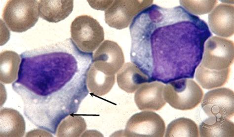 Infectious mononucleosis and atypical lymphocytosis on a smear | Medical Laboratories