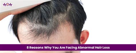 8 Reasons Why You Are Facing Abnormal Hair Loss - WoW Health Pkaistan