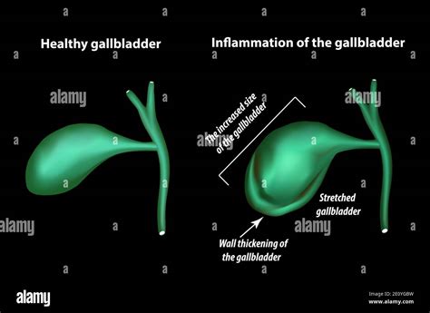 Symptoms of gallbladder inflammation. Cholecystitis. Thickening of the ...