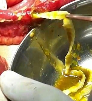 Stomach-churning footage shows surgeons removing a SIX FOOT-long worm ...