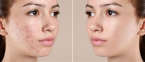 Acne Scar Treatment Cost In Hyderabad