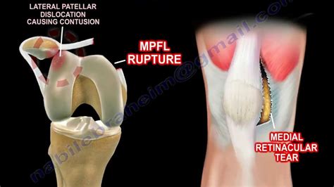 Anatomy Of The Patella - Anatomical Charts & Posters