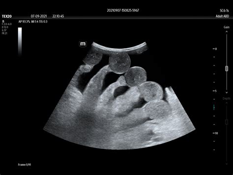 Point of Care Ultrasound System | TEX20 Series - Mindray