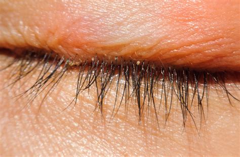 Blepharitis: the Low-Down on Scaly, Itchy Eyelids | MyDryEye