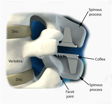 Coflex Interlaminar Device - Drwolgin