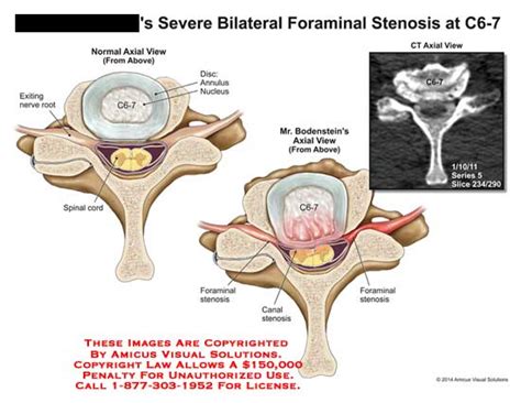 AMICUS Illustration of amicus,injury,severe,bilateral,foraminal,stenosis,C6-7,exiting,nerve,root ...