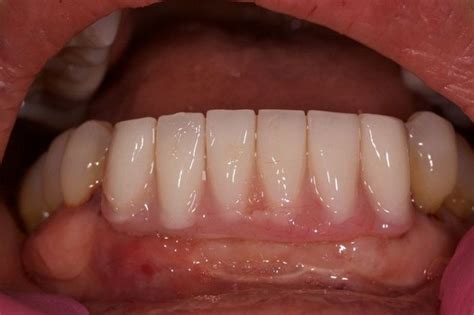 Case 2 - Dental Implant Fixed Bridge - Before and After Gallery