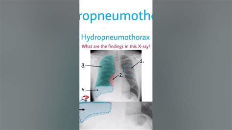 Hydropneumothorax #hydro #pneumothorax #diagnosis #cause #spotdiagnosis #clonus #spot #tounges ...