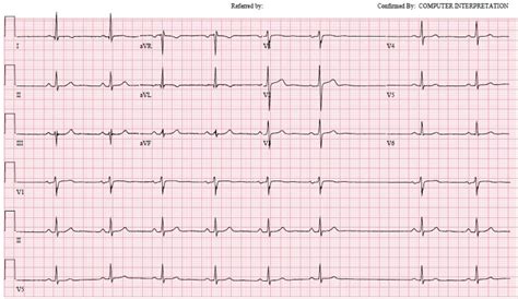 Sick sinus syndrome and pacemaker - sekaforms