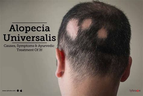 Alopecia Universalis - Causes, Symptoms & Ayurvedic Treatment Of It ...