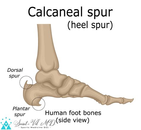 Illustration of the heel spur, which is a calcium deposit that promotes the appearance of a bone ...