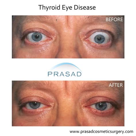 Thyroid Eye Disease Surgery/ Graves Eye Disease Surgery