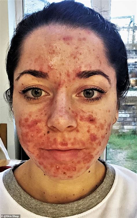 Personal trainer who had the 'worst acne ever seen' shares her striking before and after ...