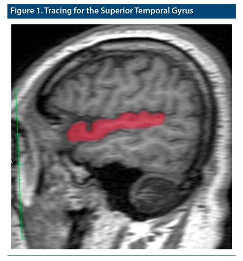 Superior Temporal Gyrus Volumes in Patients With Social Anxiety Disorder | Psychiatrist.com