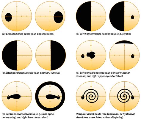 Non-glaucomatous bilateral visual field defects | (a) Enlarg… | Flickr