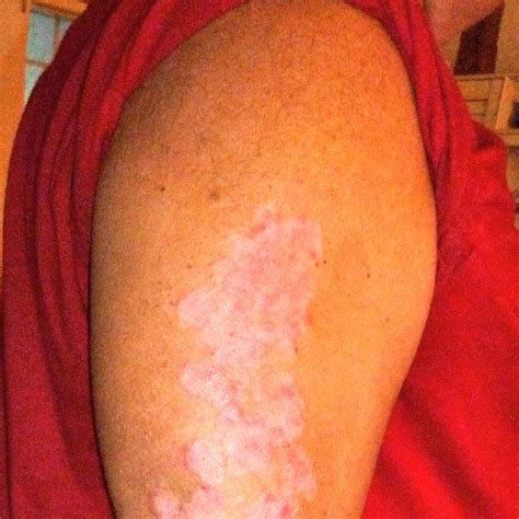 Viral Psoriasis: When a Virus Causes or Triggers Psoriasis