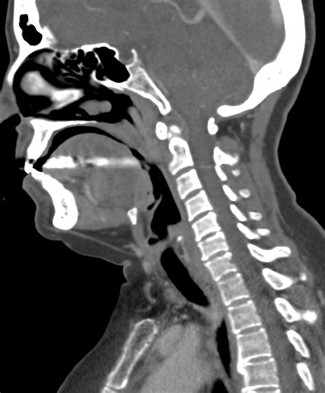 Normal Neck Ct Scan