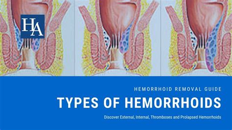 What Are Hemorrhoids Like? Discover External, Internal, Thromboses and Prolapsed Hemorrhoids ...