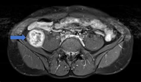 Cureus | Retroperitoneal Knee Pain: An Unusual Case Report and Review of an Ancient Schwannoma