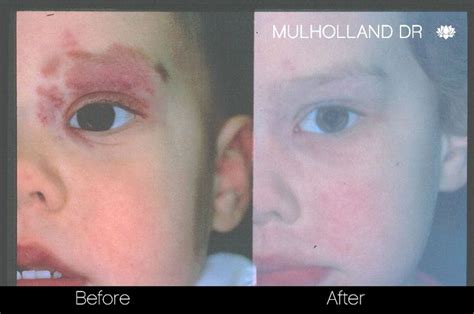 Birth Mark Removal Before and After Photos in Toronto | SpaMedica | Skin tag, Birthmark, Skin ...