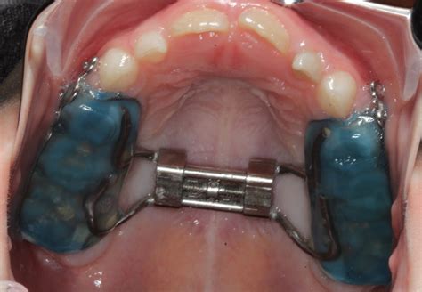 Palatal Expanders: Why, How, and When