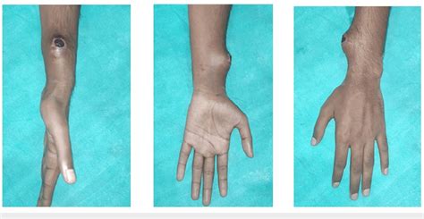 Preoperative picture of the radial artery pseudoaneurysm over the left... | Download Scientific ...