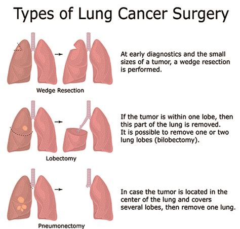 Surgical Options for Lung Cancer | Stony Brook Cancer Center