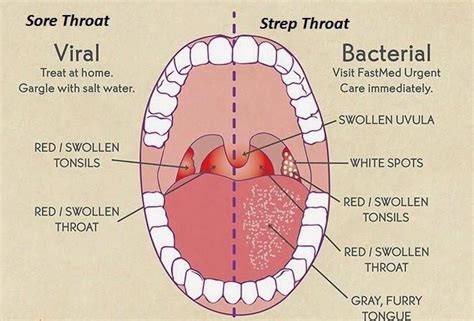 Sore Throat: Causes, Symptoms, & Remedies » How To Relief | Pharyngitis ...