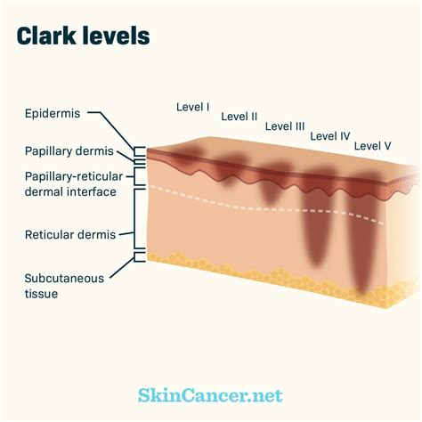 Melanoma Skin Cancer Diagram