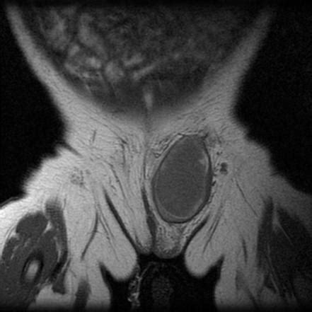 Hydrocele of the canal of Nuck | Radiology Reference Article | Radiopaedia.org