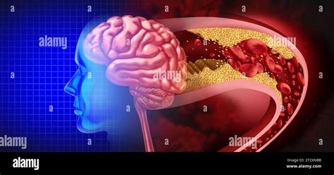 Brain Stroke Attack as a Cerebral arteriosclerosis disease as a blocked artery due to plaque ...