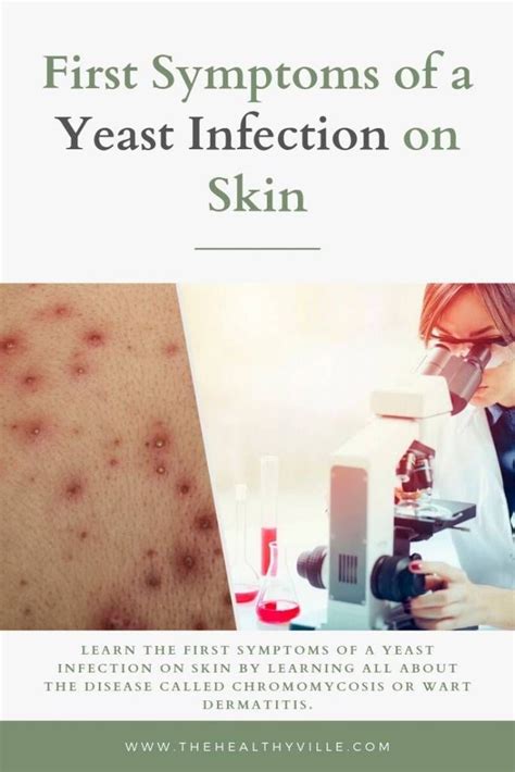 First Symptoms of a Yeast Infection on Skin | Yeast infection on skin, Yeast infection ...