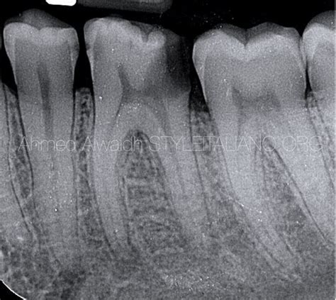 Modification in canal preparation for long and narrow canals of lower ...