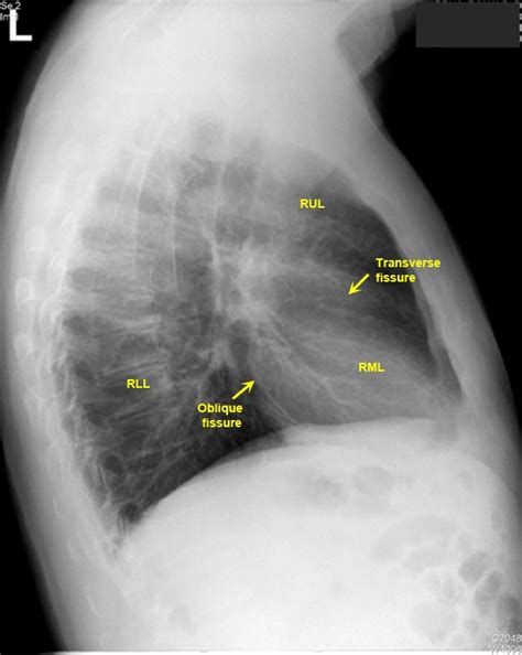 Untitled Document | Oblique fissure, Radiography, X ray