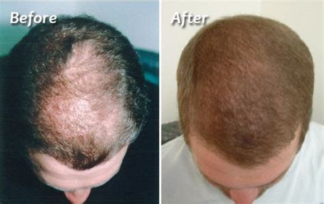 Surgical and Non-Surgical Hair Restoration Options