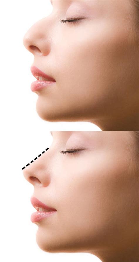 Nose Job Inland Empire│Nasal Surgery Inland Empire CA│ Nose Job Surgery