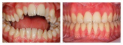 Cosmetic Dentistry Services: Teeth Straightening: Before and After ...