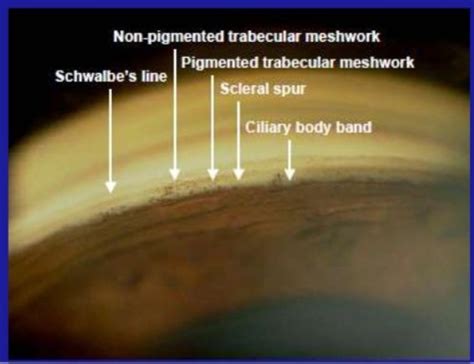 Anterior Chamber Gonioscopy Flashcards | Quizlet