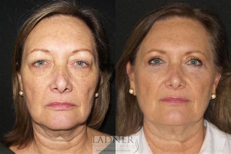 Upper Blepharoplasty Before After