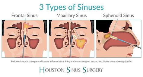 Houston Balloon Sinuplasty Surgery - Houston, TX: Houston Sinus Surgery