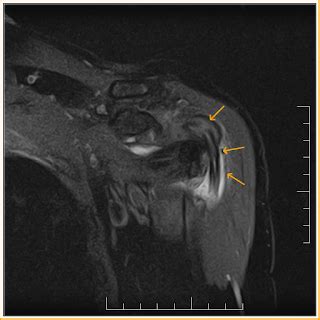 Long Head Biceps Tear-MRI - Radiology Imaging