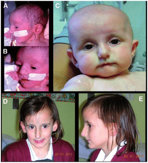 Photographs of the individual with PKCe-SHORT syndrome. (A, B) | Download Scientific Diagram