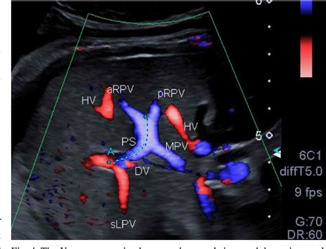 Portal Vein Anatomy Ultrasound