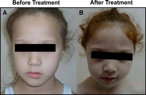 The patient before (A) and after treatment (B), showing the lack of... | Download Scientific Diagram