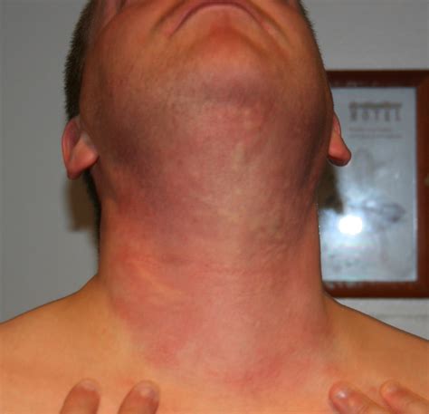 Hives on my neck after taking a reaction to the horses | Flickr