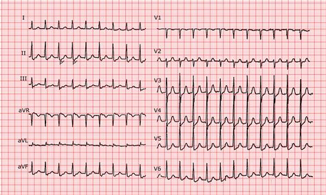 [Cardio-FR] AVNRT (nodal reentry tachycardia).