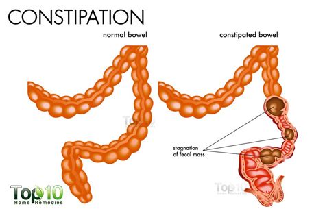 Home Remedies for Constipation | Top 10 Home Remedies