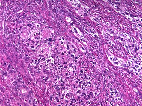 Malignant Tumor Histology